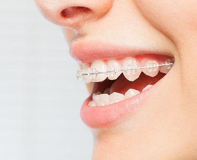 Braces Smile