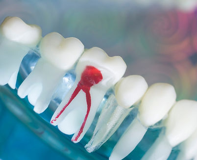 root canal